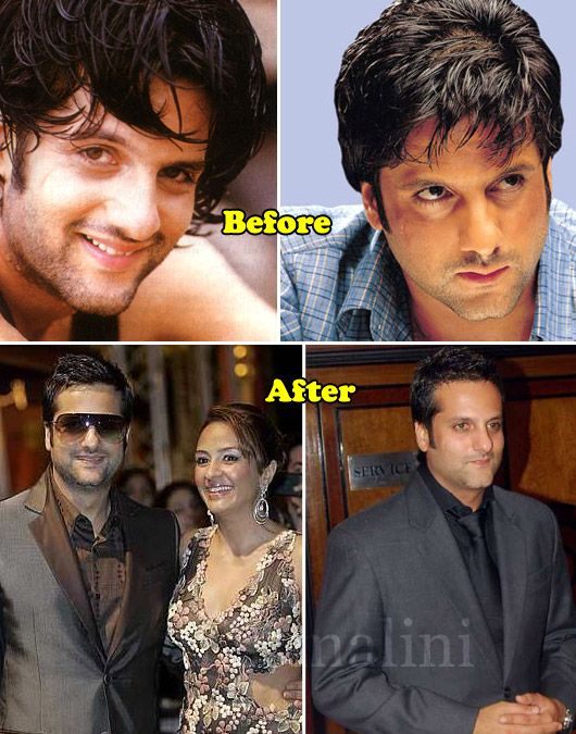 Fardeen Khan: Before & After