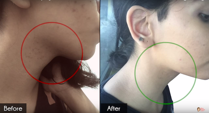 Here’s How I Got Rid Of Acne Scarring &#038; Pigmentation in 2 Weeks!
