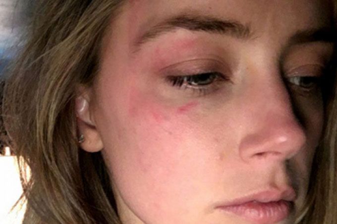Photos Of Johnny Depp’s Alleged Domestic Violence On Amber Heard