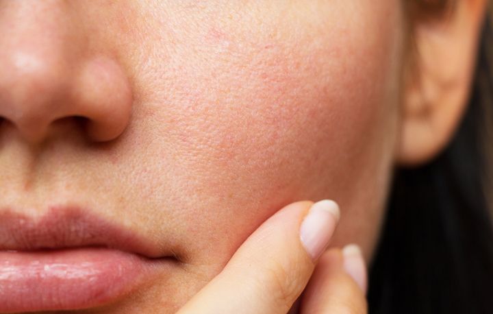 5 Things Every Girl With Sensitive Skin Needs To Know
