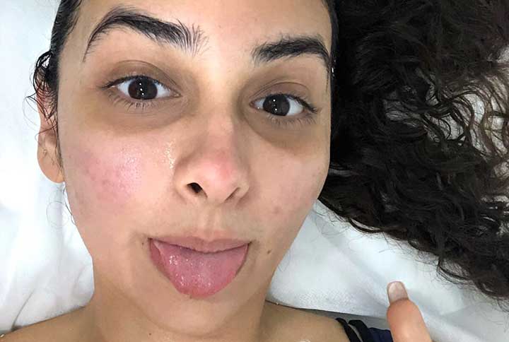 Here’s What I Thought About The Hollywood’s Most Talked About Treatment—The HydraFacial