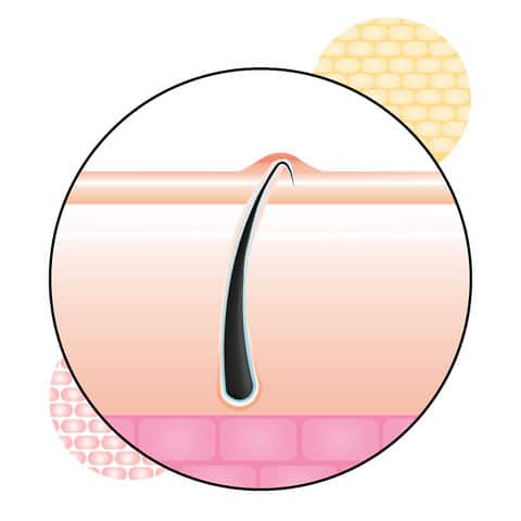 Everything You Need To Know About Dealing With Ingrown Hair