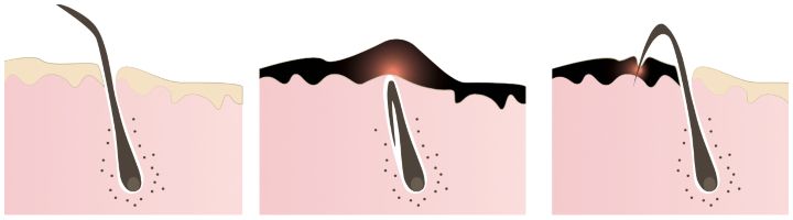 Structure of the hair follicle, ingrown hairs when shaving by Bordyug Anna | www.shutterstock.com