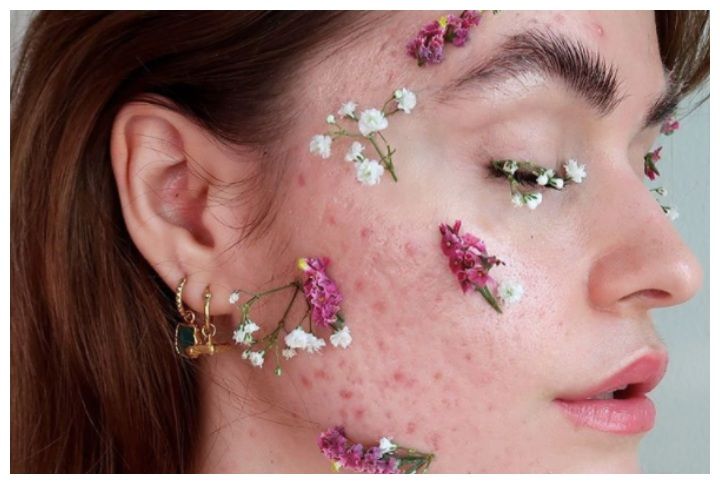 3 Skin-Positive Influencers You Need To Follow On Instagram