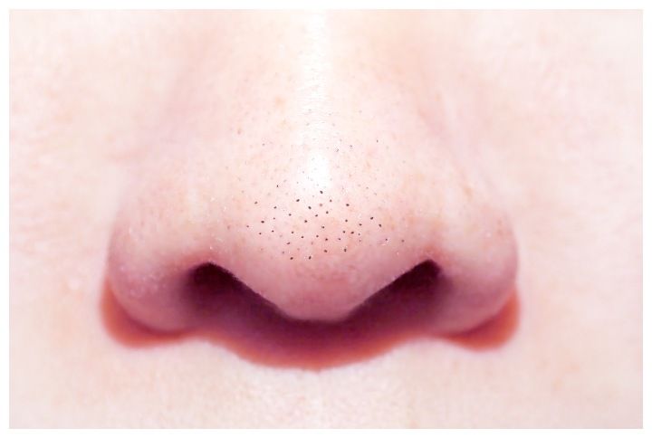 Blackheads by Artorn Thongtukit _ www.shutterstock.com