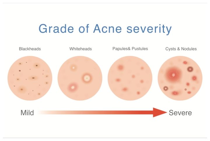 Grade of acne severity by Solar22 | www.shutterstock.com