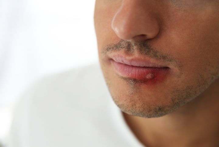 Herpes On Lip Symptom By New Africa | www.shutterstock.com