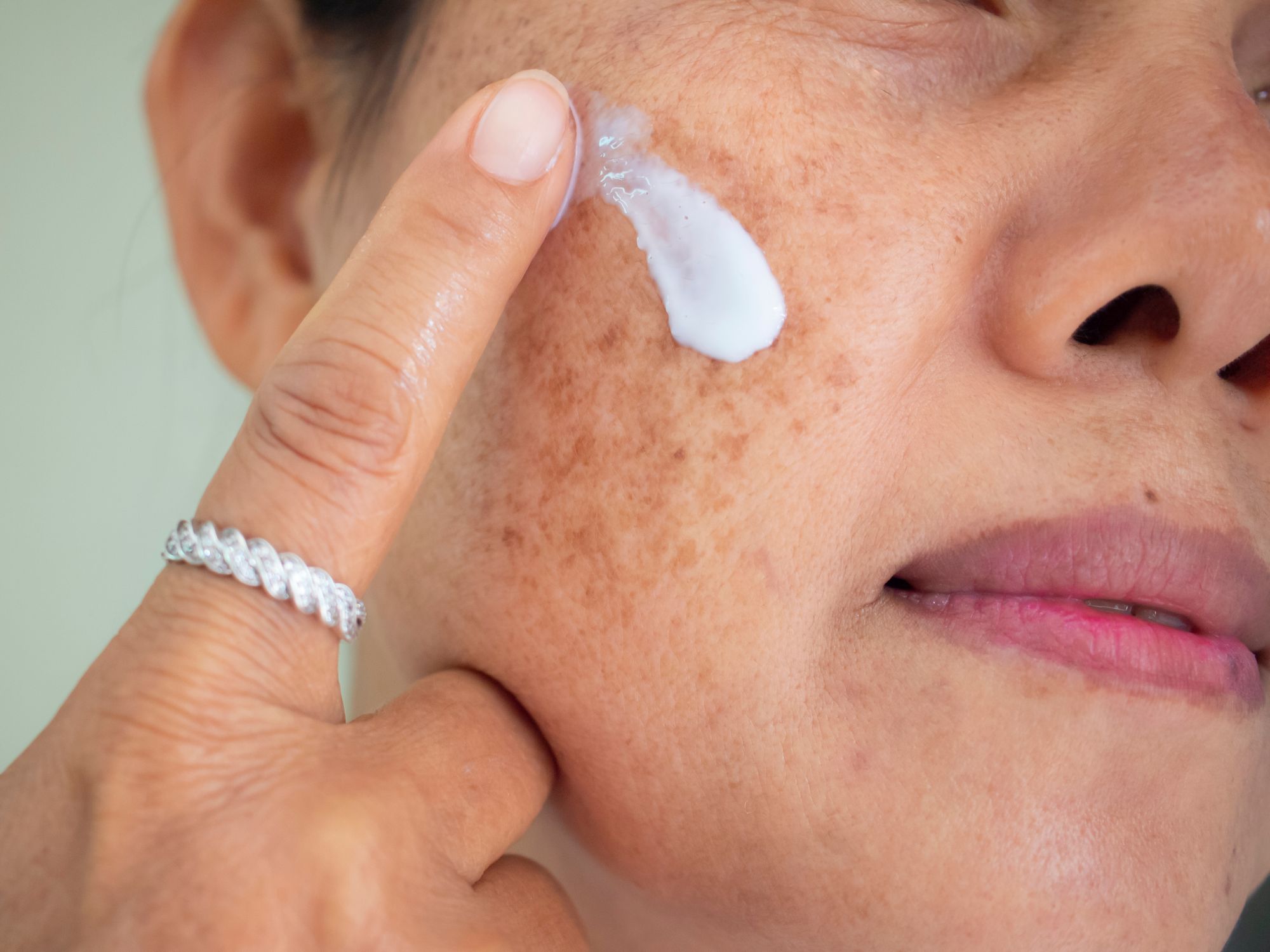 We Asked A Celebrity Dermatologist On How To Treat & Tackle Pigmentation