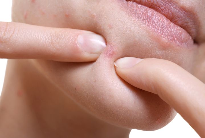 10 Reasons Your Skin Is Suddenly Breaking Out