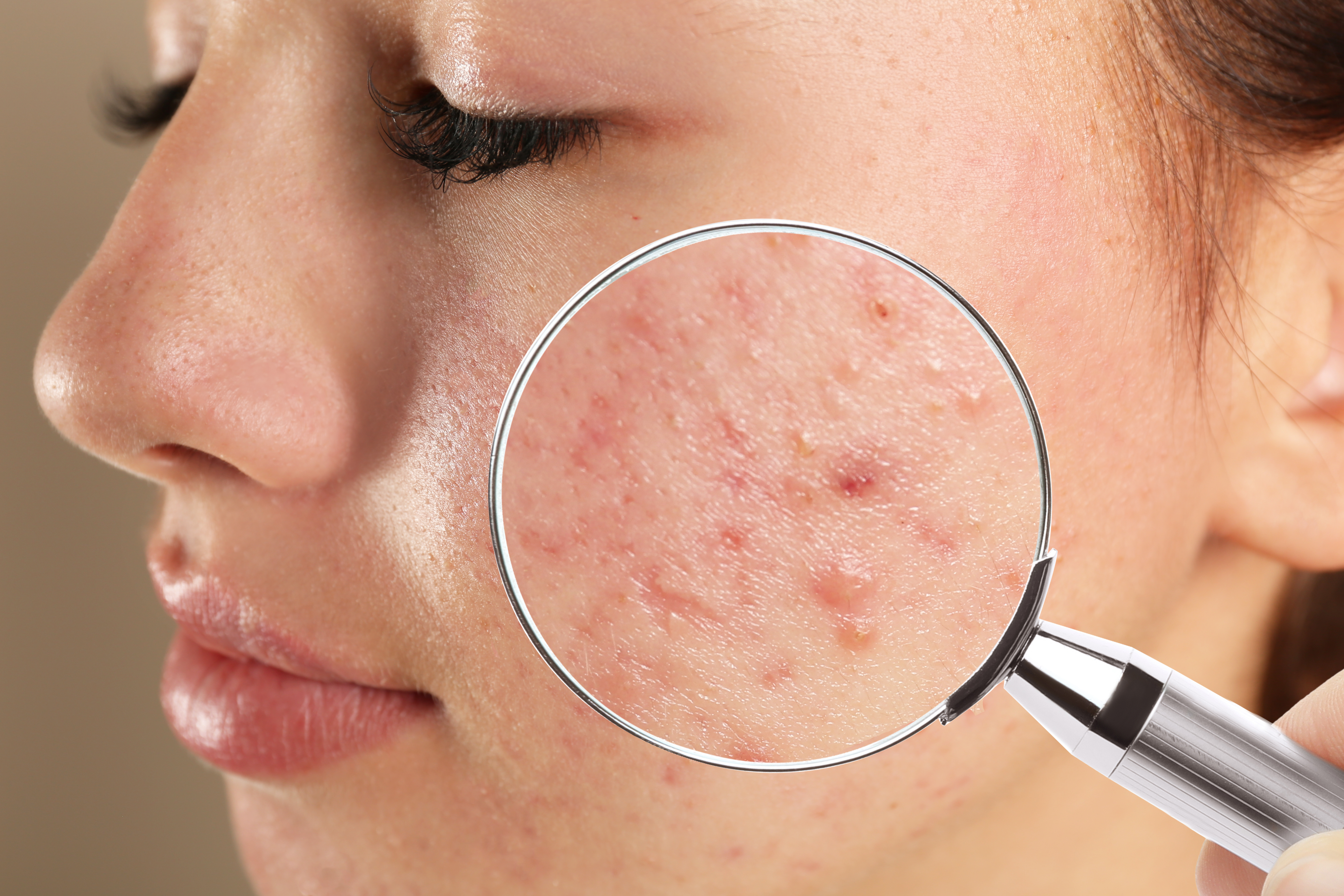 We Asked A Dermatologist About Hormonal Acne And Here’s What She Had To Say About It